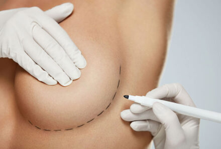 Protesi al seno: come scegliere quelle più adatte a te